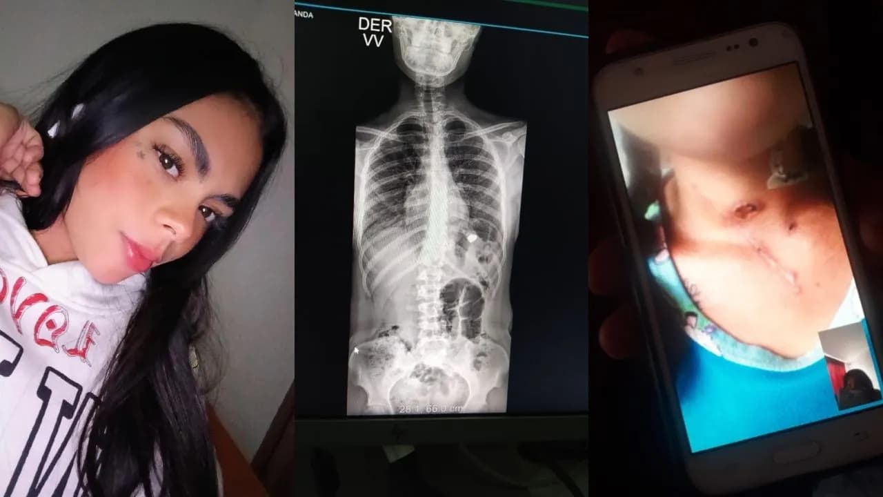 Mujer con bala en un pulmón Mujer con bala en un pulmón