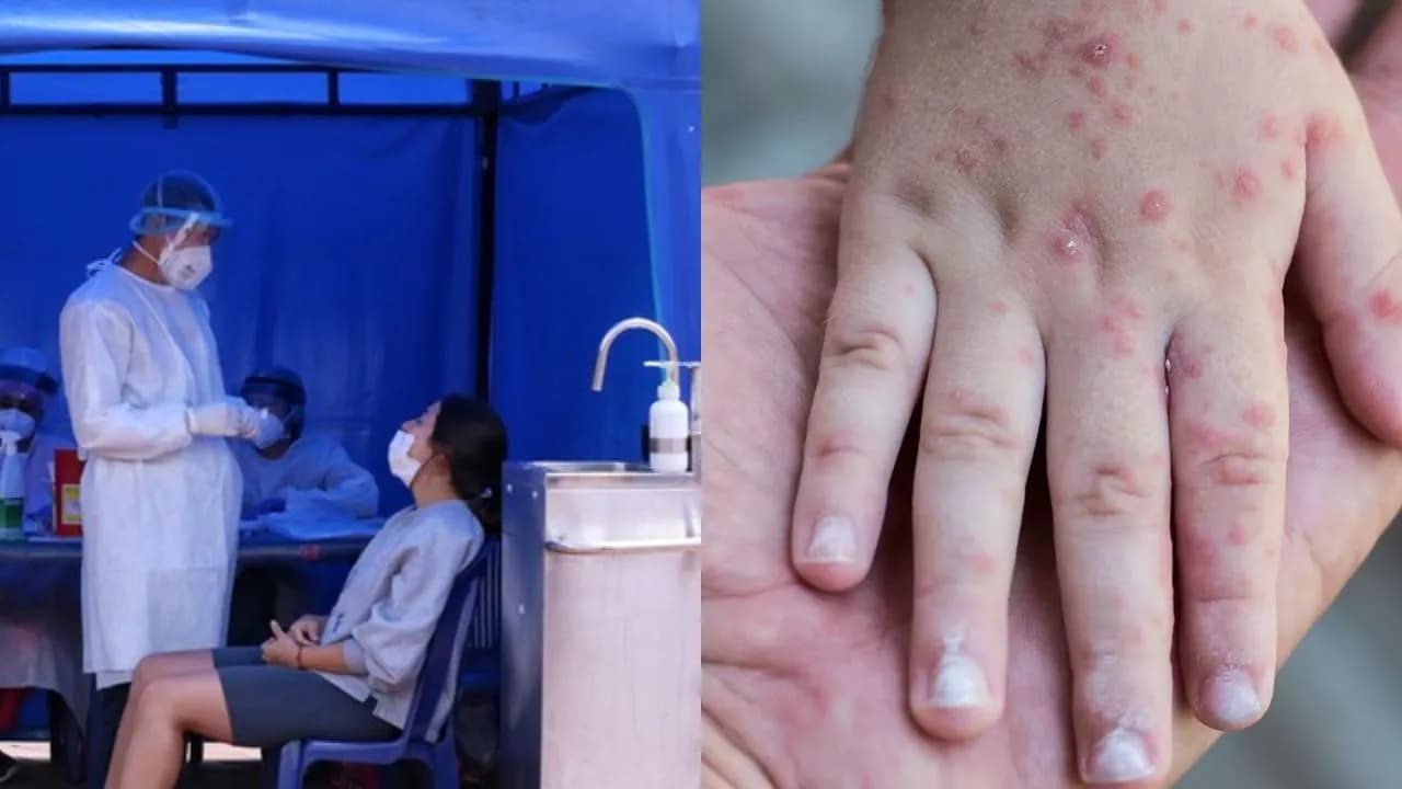 Brote de virus Coxsackie Brote de virus Coxsackie